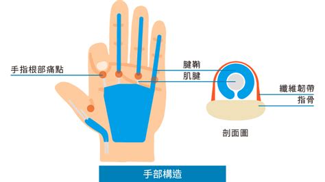 手指腫脹無法彎曲|板機指多久會好？了解板機指原因、舒緩復健方式及自我治療方法